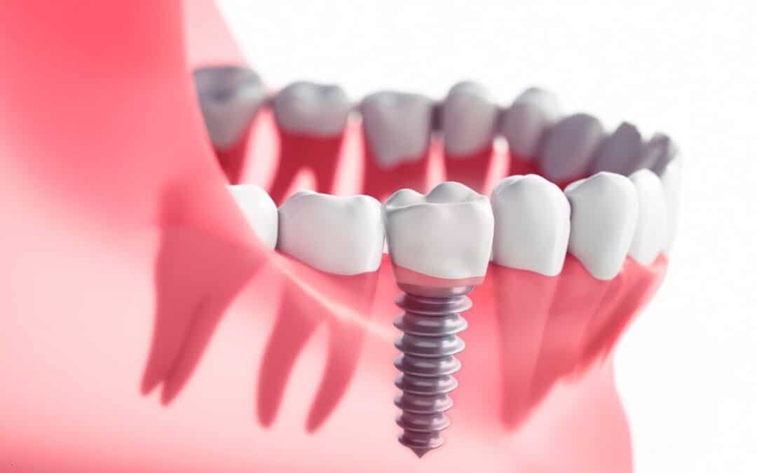 The Truth About Dental Implants: Weighing the Benefits and Drawbacks