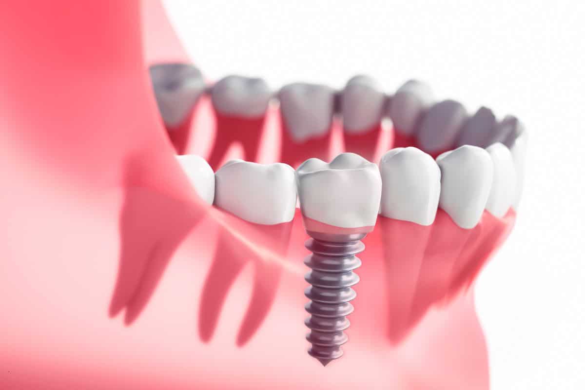 dental-implants-benefits-and-drawbacks Dental Implants Sandy