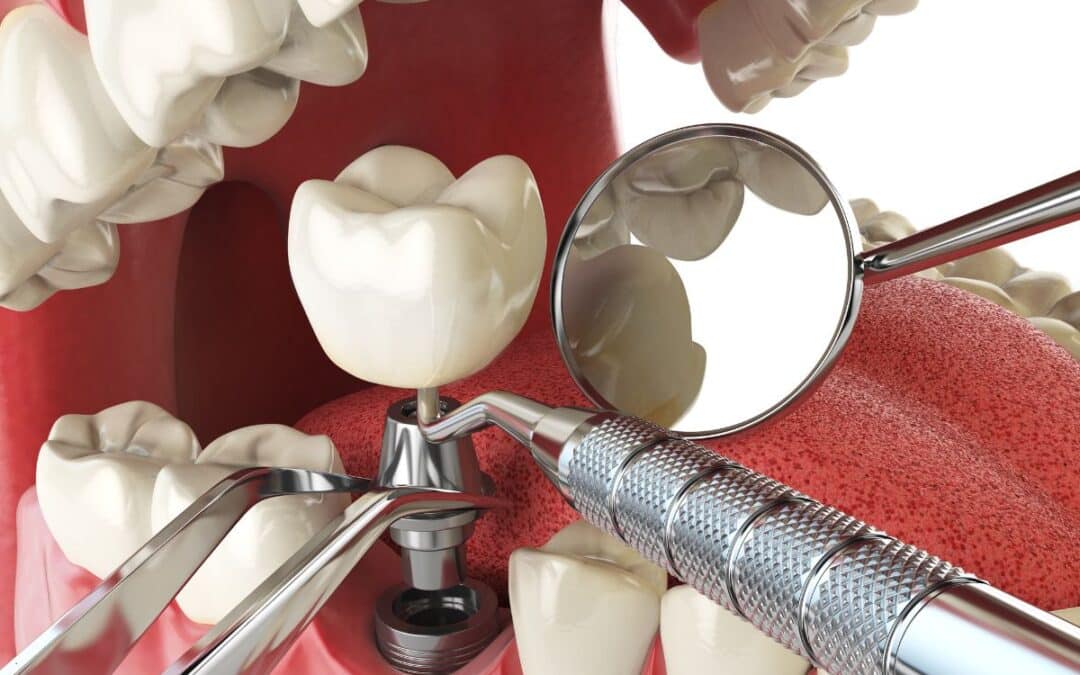 Are Dental Implants Safe? A Guide to Risks & Success Rates