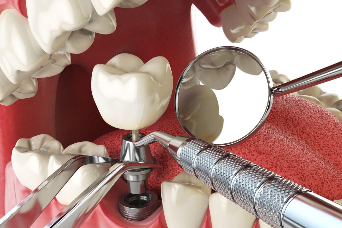Dental Implants Sandy