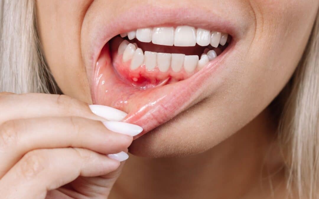 3 Steps to Improve Gum Health