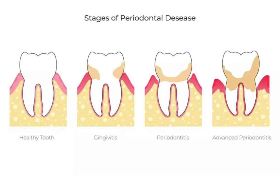 What are the Different Stages of Periodontal Disease?