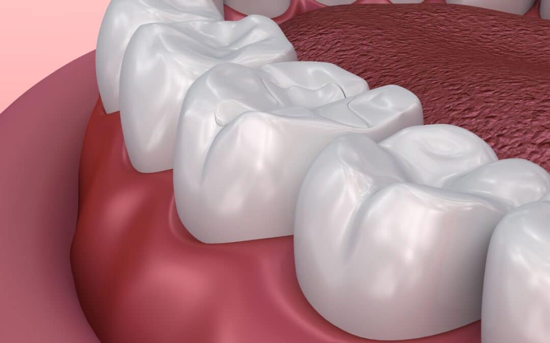 What To Expect During A Dental Sealant Procedure?