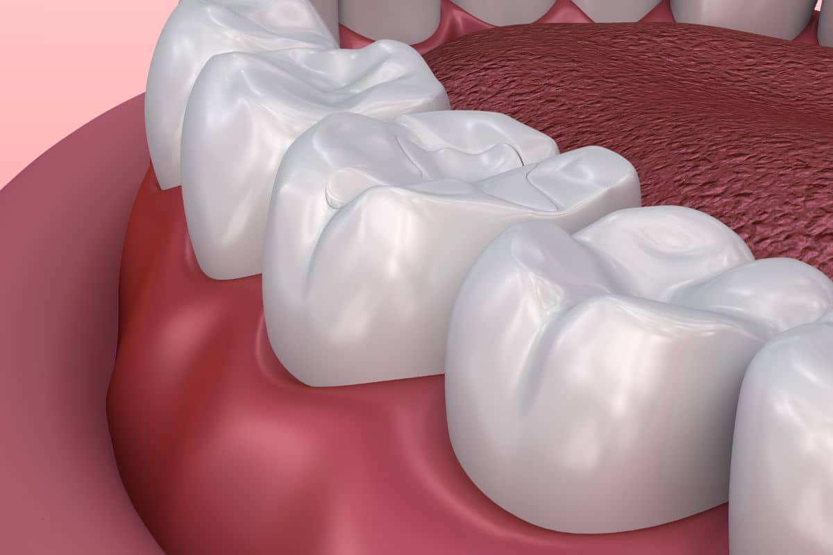 what-to-expect-dental-sealant-procedure Dentist Sandy UT