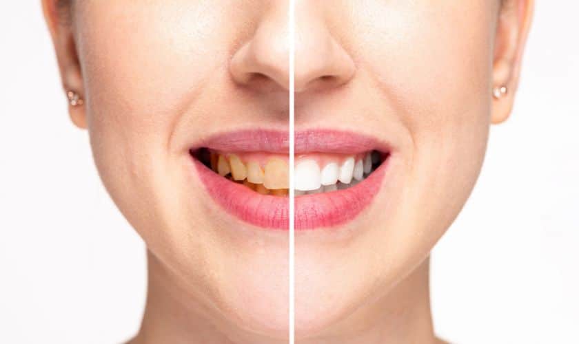 Illuminate Your Smile: Discover The Magic Of Teeth Whitening In Sandy