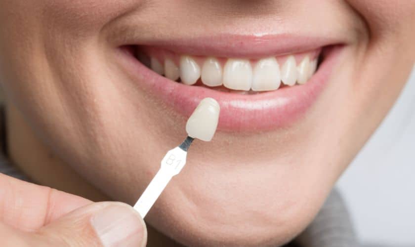 Veneers in Sandy The Artistry Of Veneers: Transforming Your Smile With Cosmetic Dentistry