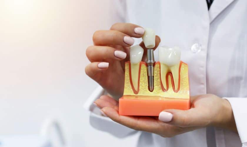 Dental Implants Sandy Dental Implants Sandy