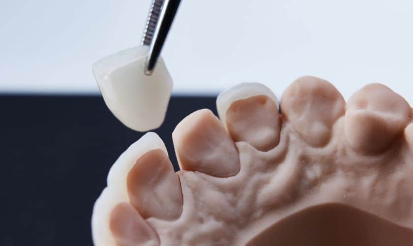 CEREC® Crowns Dentist in Sandy