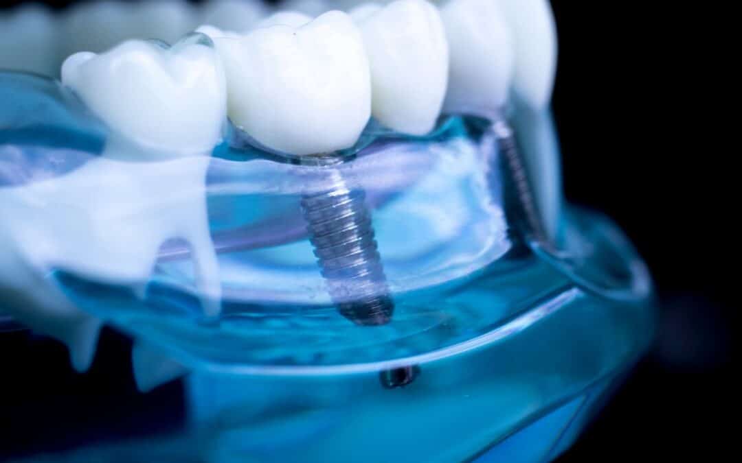 How Painful is Getting a Dental Implant?