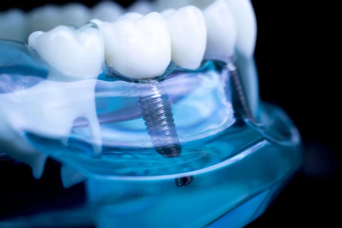 dental-implant-pain-recovery Dental Implants Sandy