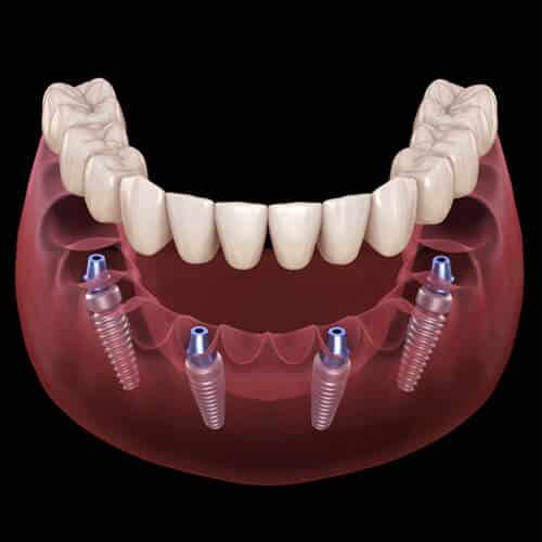 All-on-4 dental implants in Sandy, UT All-on-4 dental implants in Sandy