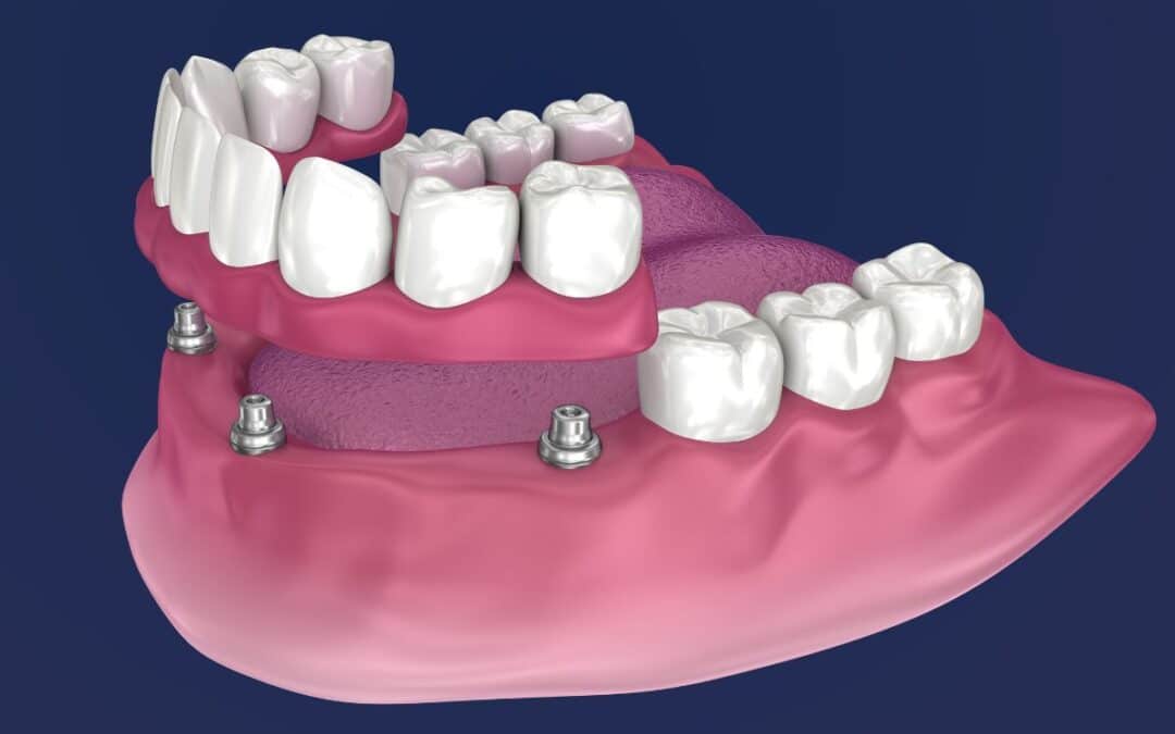 Can You Get All-on-4 Dental Implants If You Have Bone Loss?