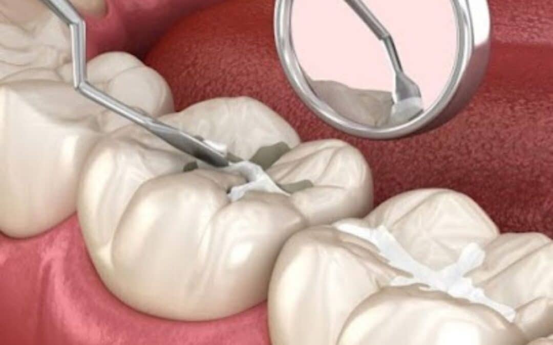 Dental Sealants for Sensitive Teeth: Can They Help?