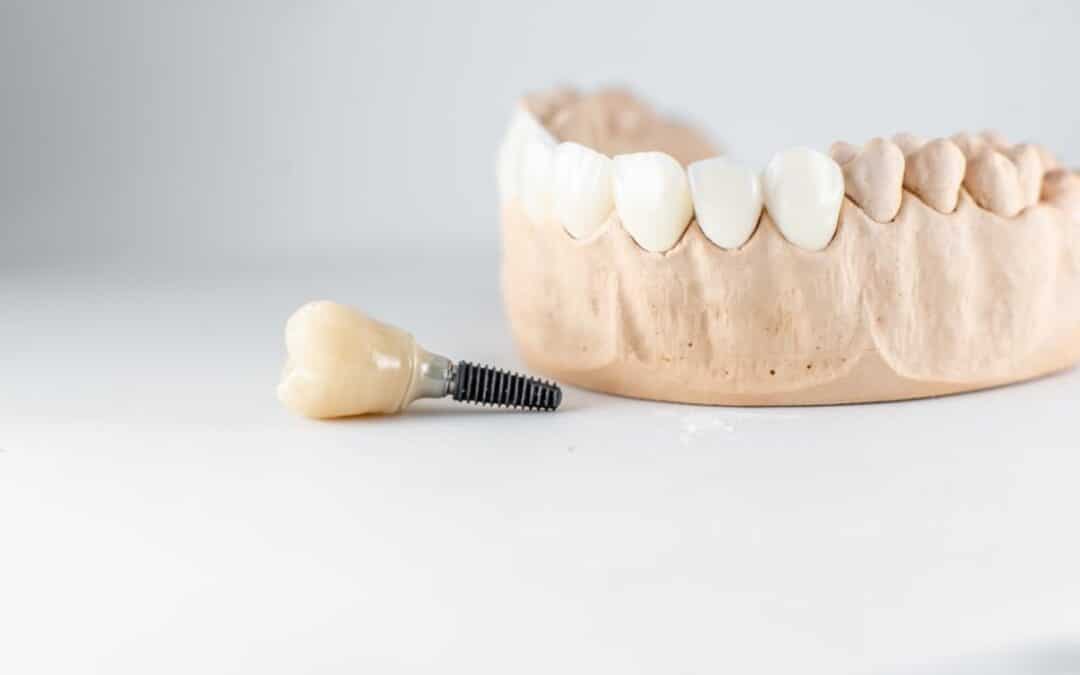 Can Dental Implants Help with Bone Loss?