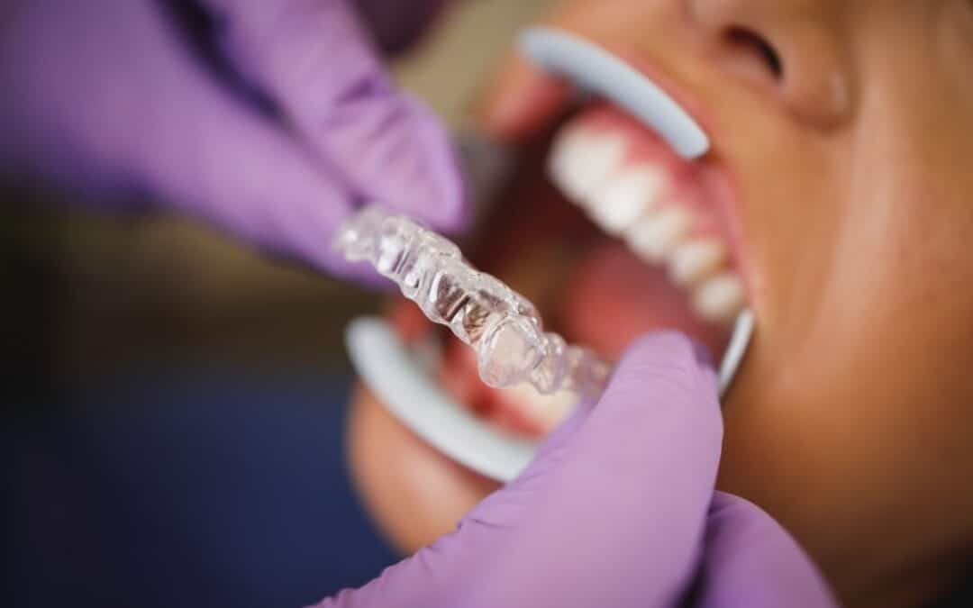 Why Invisalign Is the Most Comfortable Way to Straighten Your Teeth in Sandy?