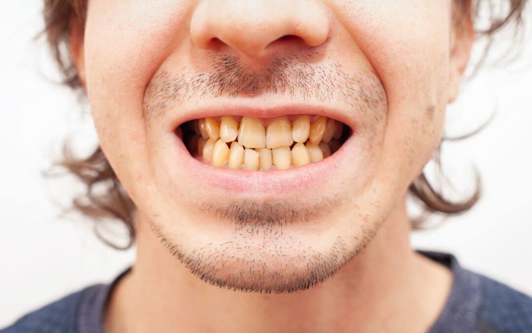 Can Rotten Teeth Be Fixed?
