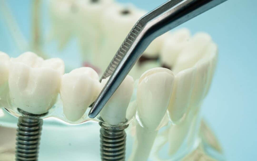 Can One Dental Implant Support Two Teeth?