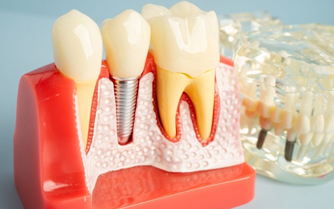 How Long Do Dental Implants Last? Insights from canyons family dental