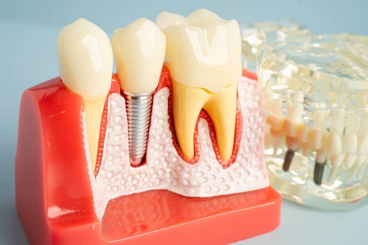 Dental Implants