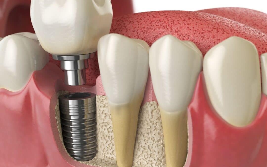 Dental Implant Options for Bone Loss: What Treatments Are Available?