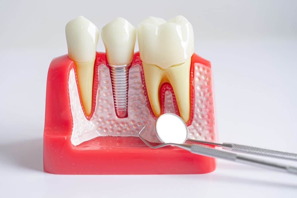 dental-implant-artificial-tooth-roots