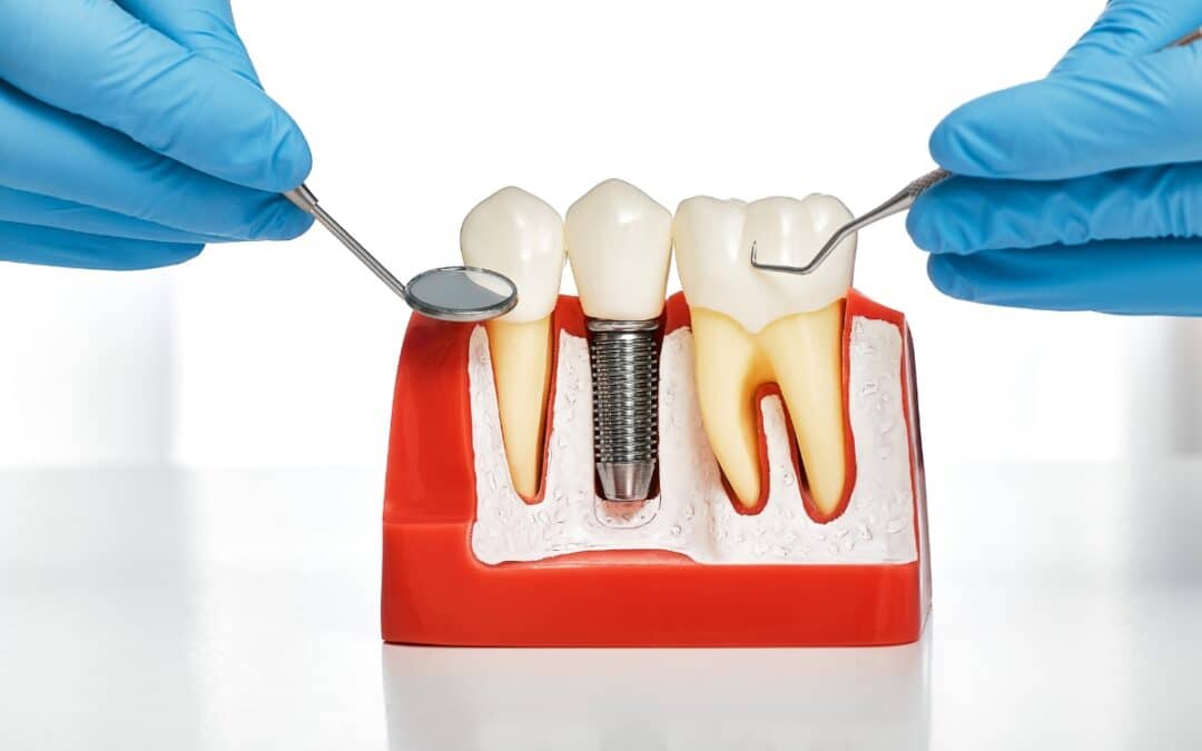 How Replacing Missing Teeth with Implants Improves Overall Health