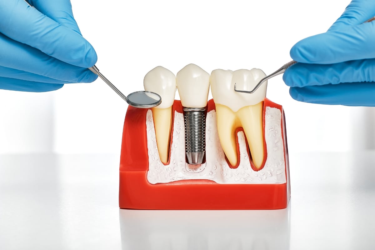 replacing-missing-teeth-with-implants Replacing Missing Teeth with Implants