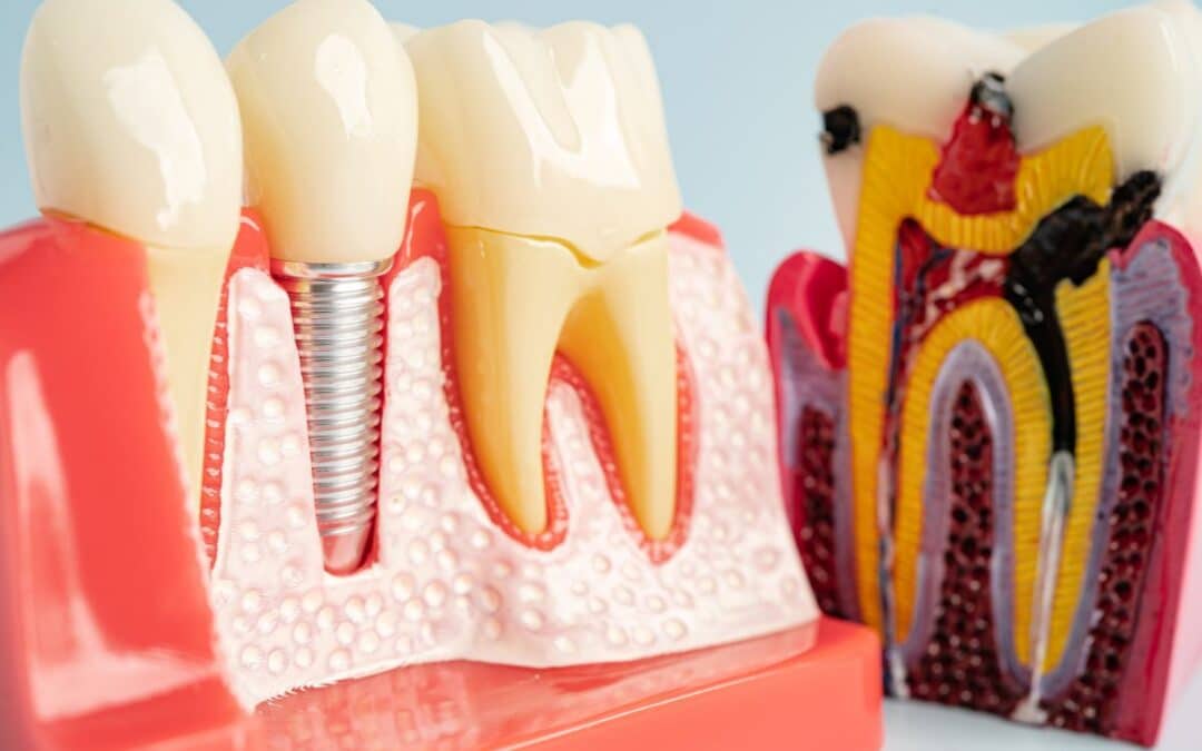 How Smoking and Diabetes Affect Dental Implant Healing