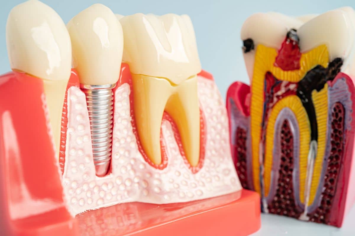 dental implant healing dental implant healing