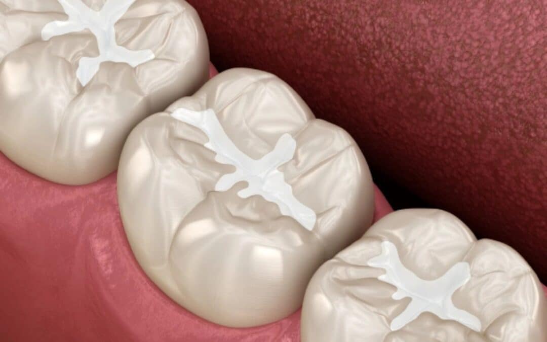 Are Dental Sealants Safe for Sensitive Teeth? What Dentists Recommend
