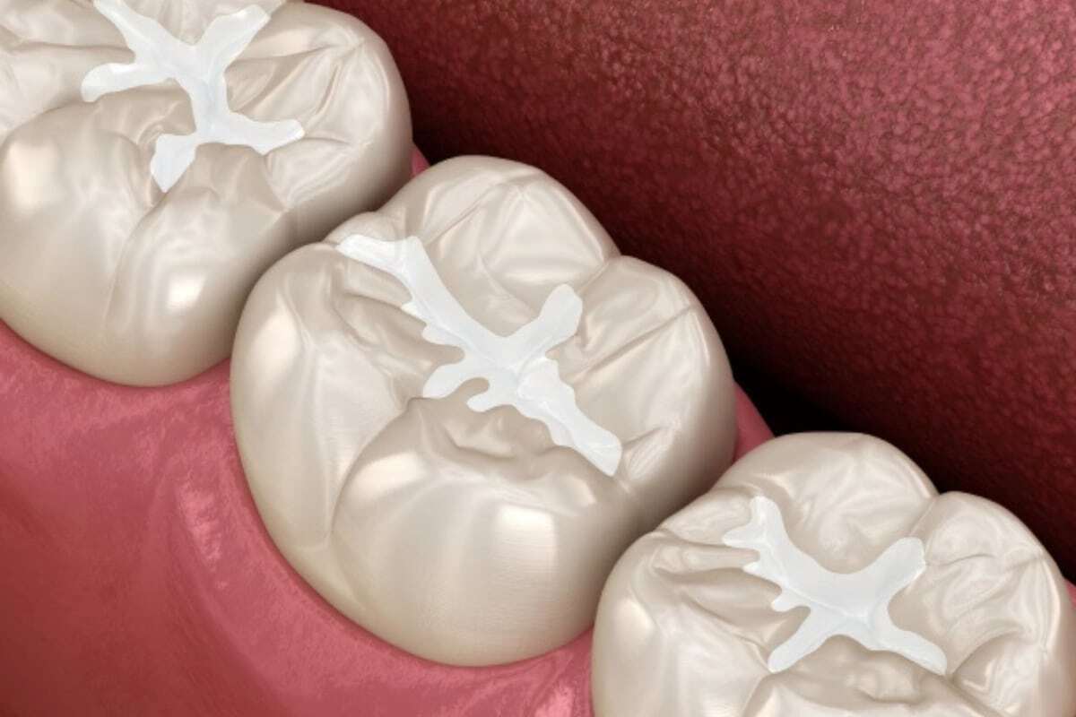 Dental Sealants Dental sealants applied to molars to protect against decay and cavities.