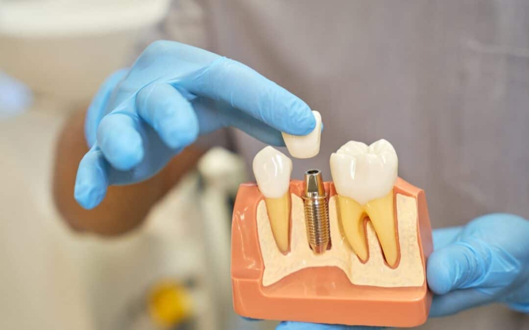 Can Dental Implants Contribute to a Longer Lifespan?