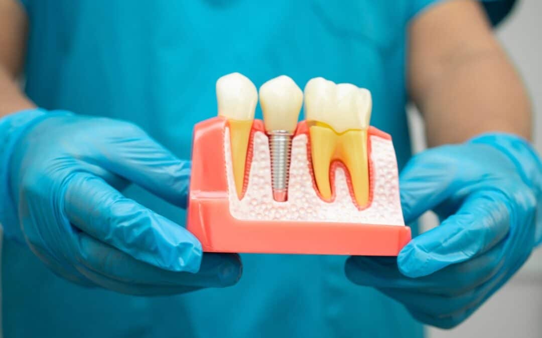 Can Dental Implants Help Restore Your Smile After Tooth Loss?