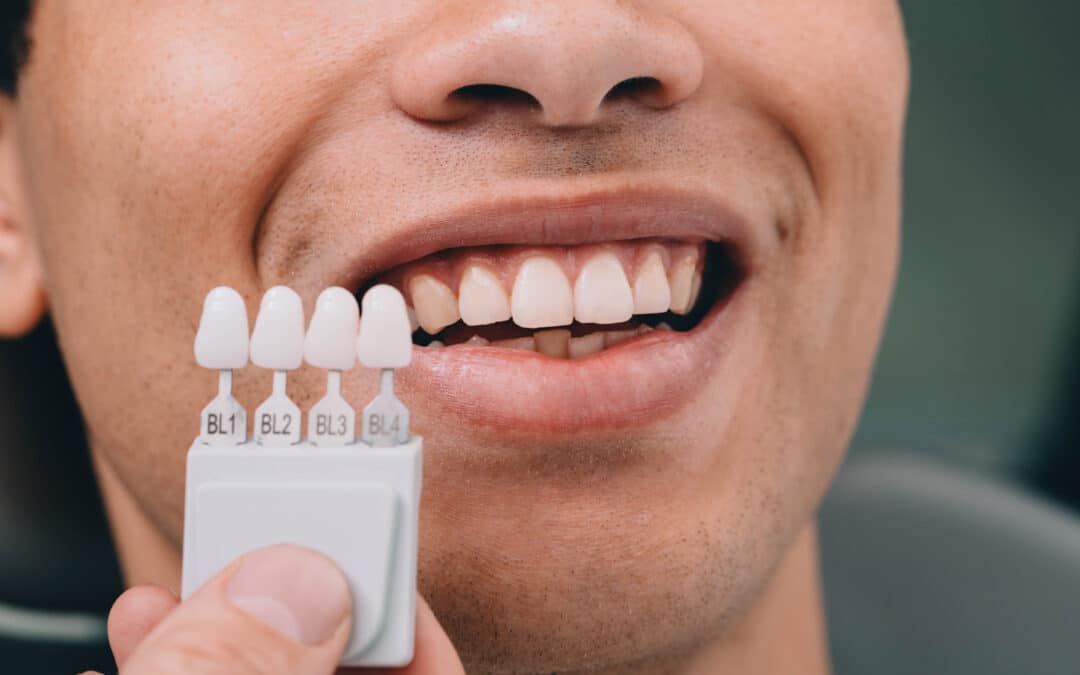Veneers vs Bonding: Which Smile Fix Actually Lasts Longer